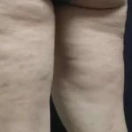 Cellulaze Before & After Patient #383