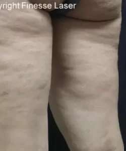 Cellulaze Before & After Patient #383