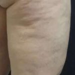 Cellulaze Before & After Patient #386