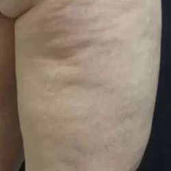 Cellulaze Before & After Patient #386