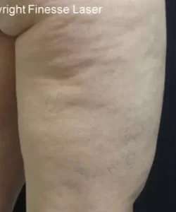 Cellulaze Before & After Patient #386