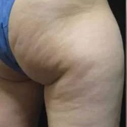 Cellulaze Before & After Patient #389