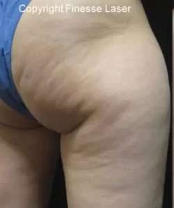 Cellulaze Before & After Patient #389