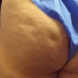 Cellulaze Before & After Patient #392