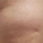 Cellulaze Before & After Patient #395