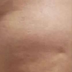 Cellulaze Before & After Patient #395