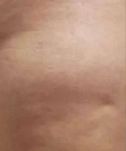 Cellulaze Before & After Patient #395