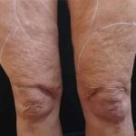 Morpheus8 Before & After Patient #398