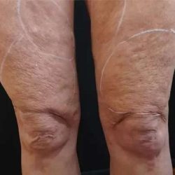 Morpheus8 Before & After Patient #398