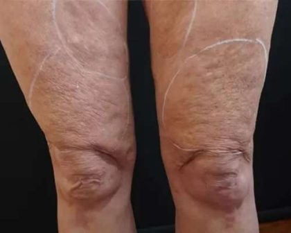 Morpheus8 Before & After Patient #398