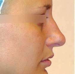 Rhinoplasty Before & After Patient #69