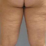 Smartlipo Vaser Lipo Before & After Patient #499