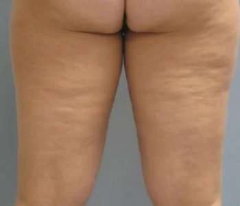 Smartlipo Vaser Lipo Before & After Patient #499