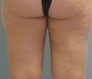 Smartlipo Vaser Lipo Before & After Patient #516