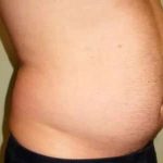 Smartlipo Vaser Lipo Before & After Patient #536