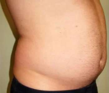 Smartlipo Vaser Lipo Before & After Patient #536