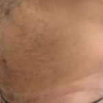 Smartlipo Vaser Lipo Before & After Patient #544