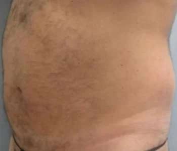 Smartlipo Vaser Lipo Before & After Patient #544