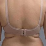 Smartlipo Vaser Lipo Before & After Patient #561