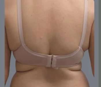 Smartlipo Vaser Lipo Before & After Patient #561