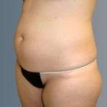 Smartlipo Vaser Lipo Before & After Patient #624
