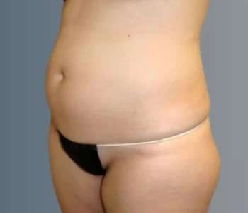 Smartlipo Vaser Lipo Before & After Patient #624