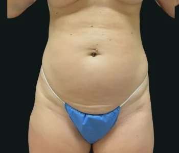 Smartlipo Vaser Lipo Before & After Patient #680