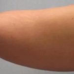 Smartlipo Vaser Lipo Before & After Patient #483