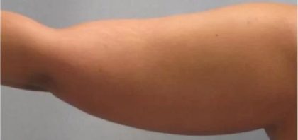Smartlipo Vaser Lipo Before & After Patient #483