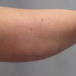 Smartlipo Vaser Lipo Before & After Patient #491