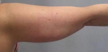 Smartlipo Vaser Lipo Before & After Patient #491
