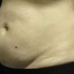 Coolsculpting Before & After Patient #259