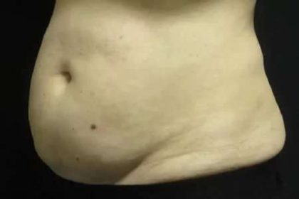 Coolsculpting Before & After Patient #259
