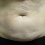 Coolsculpting Before & After Patient #288