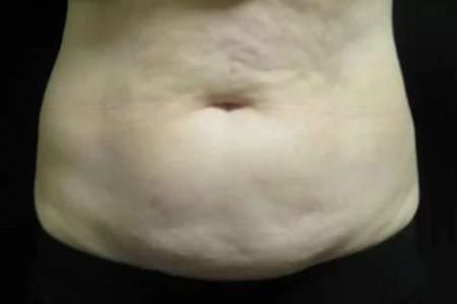Coolsculpting Before & After Patient #288