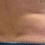 Coolsculpting Before & After Patient #296