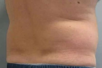 Coolsculpting Before & After Patient #296