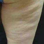Cellulaze Before & After Patient #362