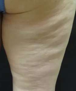Cellulaze Before & After Patient #362