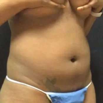 Smartlipo Vaser Lipo Before & After Patient #445