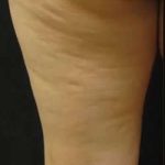 Cellulaze Before & After Patient #362