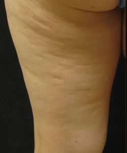 Cellulaze Before & After Patient #362