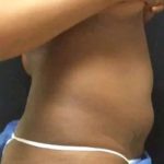 Smartlipo Vaser Lipo Before & After Patient #445