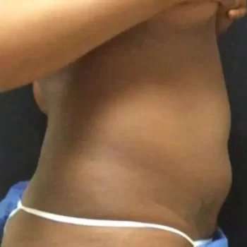 Smartlipo Vaser Lipo Before & After Patient #445