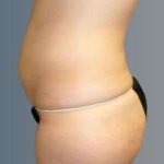 Smartlipo Vaser Lipo Before & After Patient #624