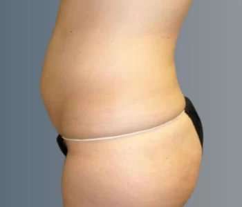 Smartlipo Vaser Lipo Before & After Patient #624