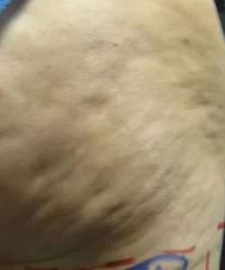 Cellulaze Before & After Patient #362