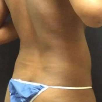 Smartlipo Vaser Lipo Before & After Patient #445
