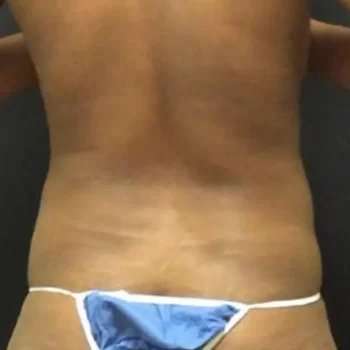 Smartlipo Vaser Lipo Before & After Patient #445