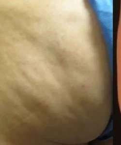 Cellulaze Before & After Patient #362